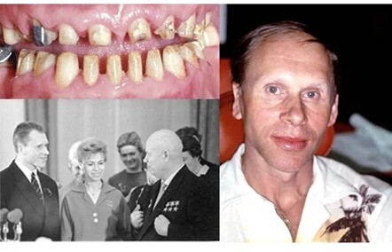 Oleg Protopopov, prior to his full-mouth reconstruction by Ultradent’s founder, Dr. Dan Fischer
