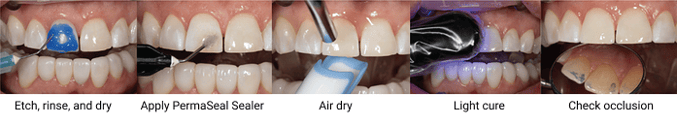 PermaSeal sealer procedure step-by-step