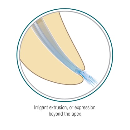 Irrigant extrusion_EU