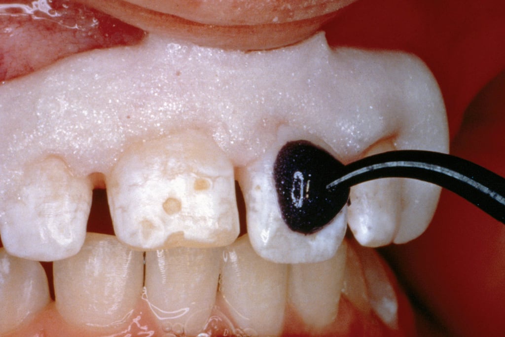 Enamel Microabrasion: Step-by-Step Technique