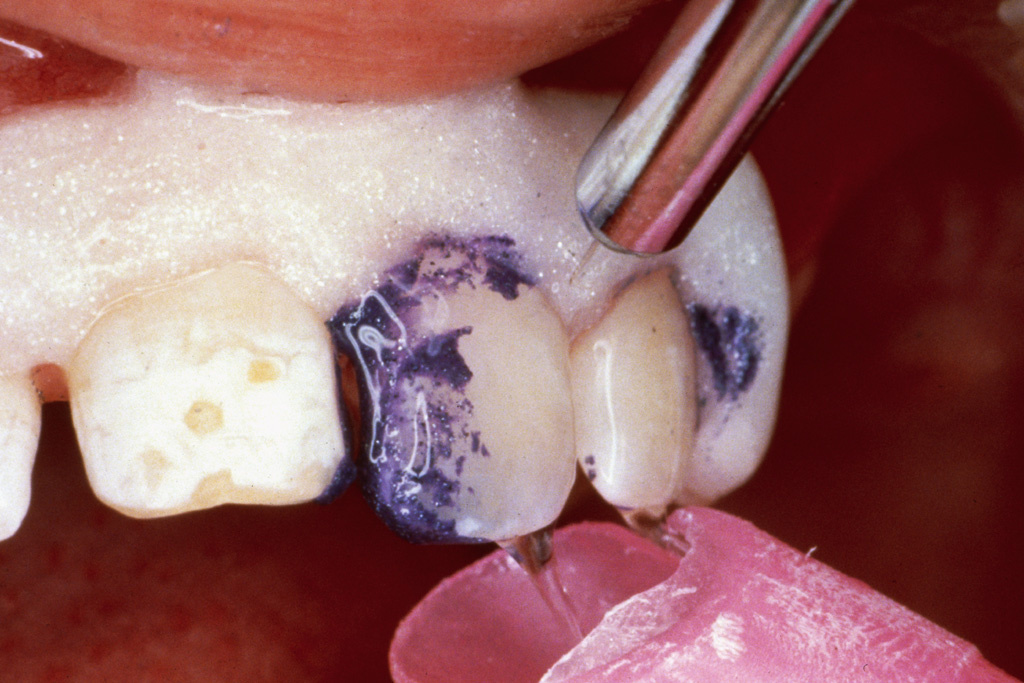 Enamel Microabrasion StepbyStep Technique