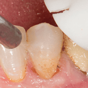 vigorous scrubbing tooth